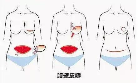 36岁女子查出乳腺癌，早期发现至关重要