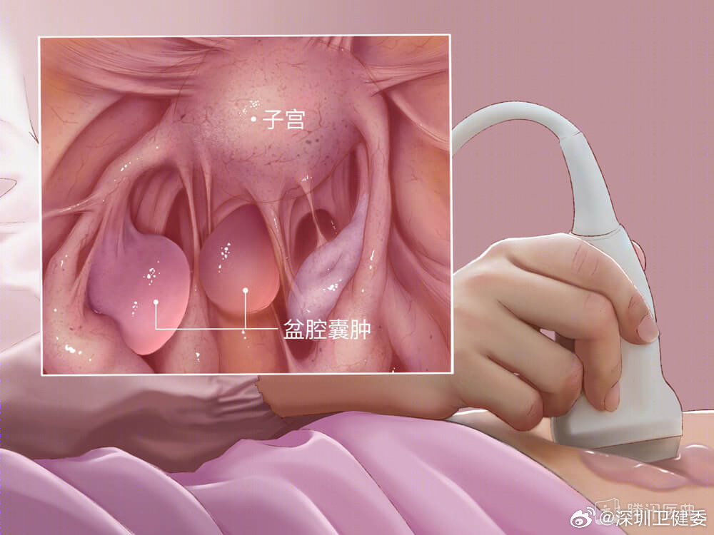 19岁女生每月3周痛经想切子宫，涉政问题的探讨